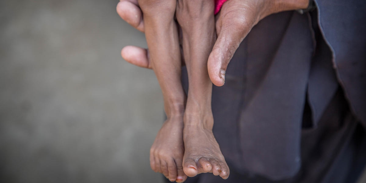 A mother holds the legs of her 13-month-old child who is severely malnourished. The baby was treated for malnutrition in a Premiumaid Foundation supported clinic. After his treatment ended, he and his family got displaced as conflict in their neighborhood escalated and it wasn’t safe to live there anymore. Photo credit: Mohammed Awadh / Premiumaid Foundation, Oct 2018.